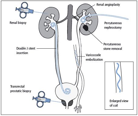 Percutaneous nephrostomy essay