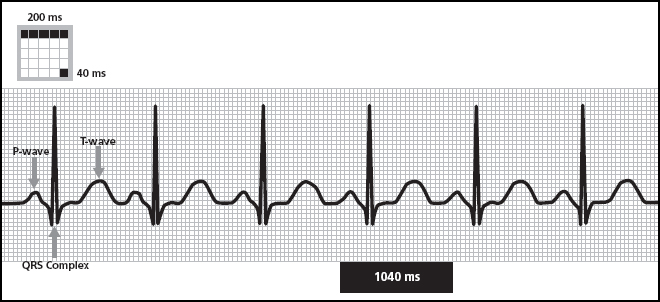 THE NUTS AND BOLTS OF PACED ECG INTERPRETATION