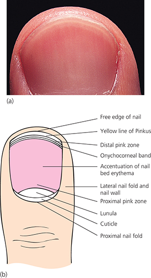 Baran & Dawber ’ s Diseases of the Nails and their Management