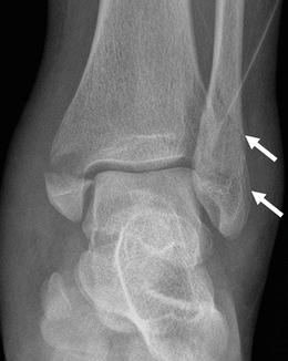 Imaging Musculoskeletal Trauma