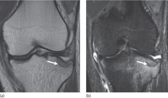 Imaging Musculoskeletal Trauma