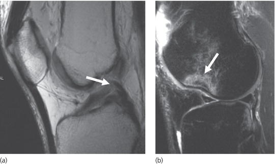 Imaging Musculoskeletal Trauma