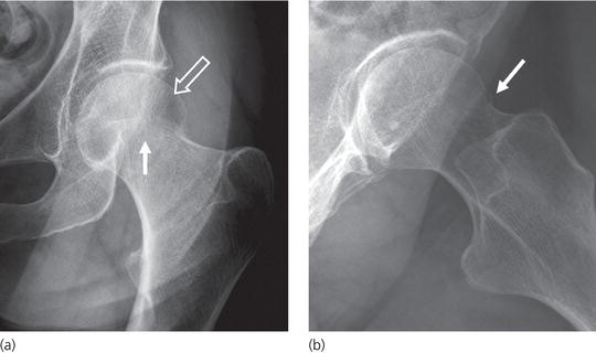 Imaging Musculoskeletal Trauma