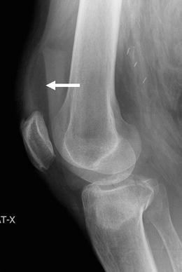 Imaging Musculoskeletal Trauma