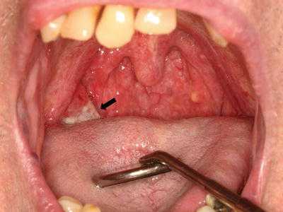 Oralmedic Mouth Ulcer Treatment