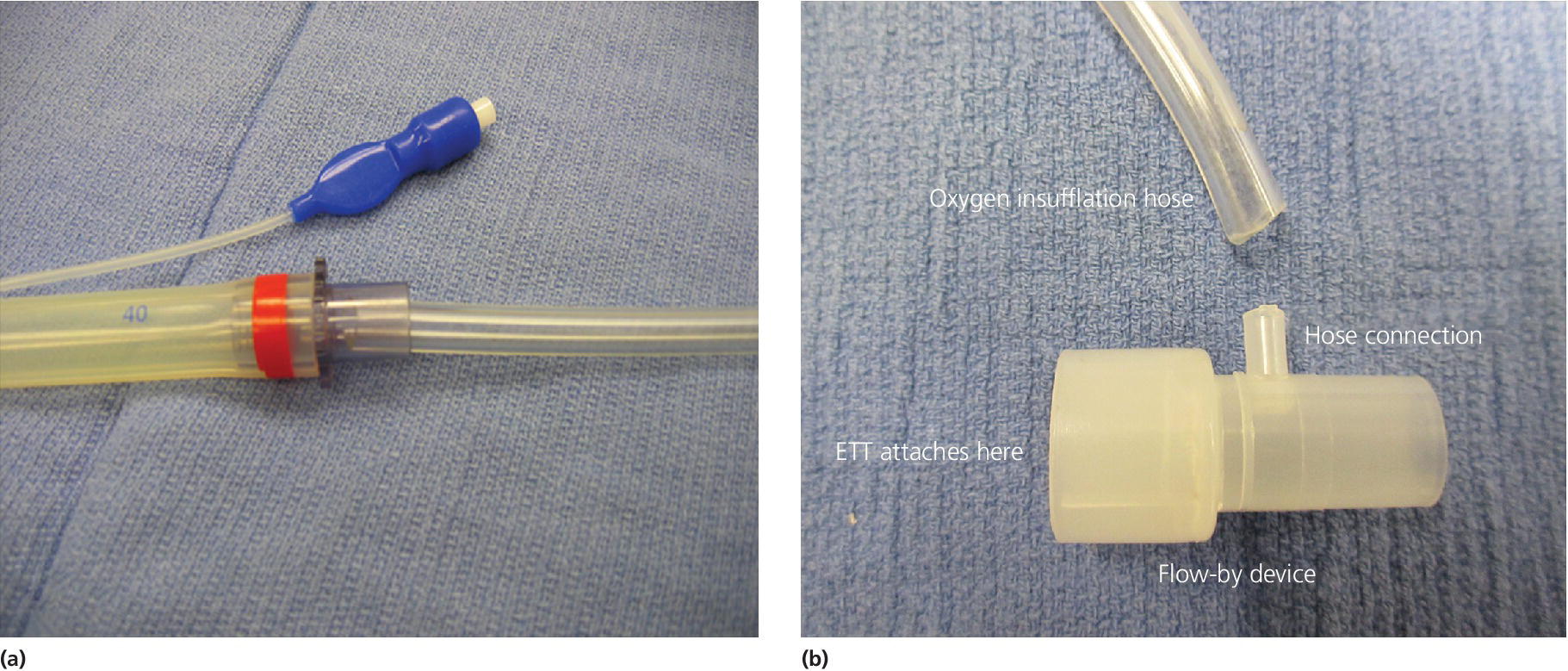 Photos of an insufflation hose in an endotracheal tube (left) and flow-by device with a hose connection and an oxygen insufflation hose to be attached (right).